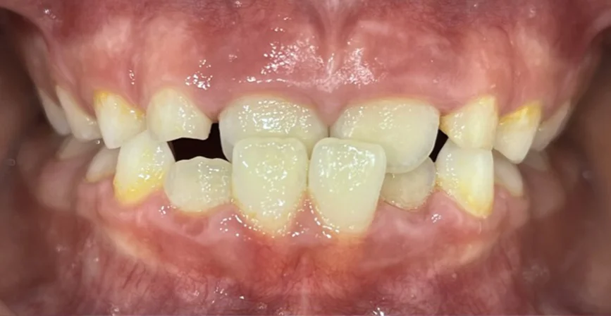 Прозрачни алайнери за деца – дете на 7 г., фронтална снимка на захапката преди лечението.