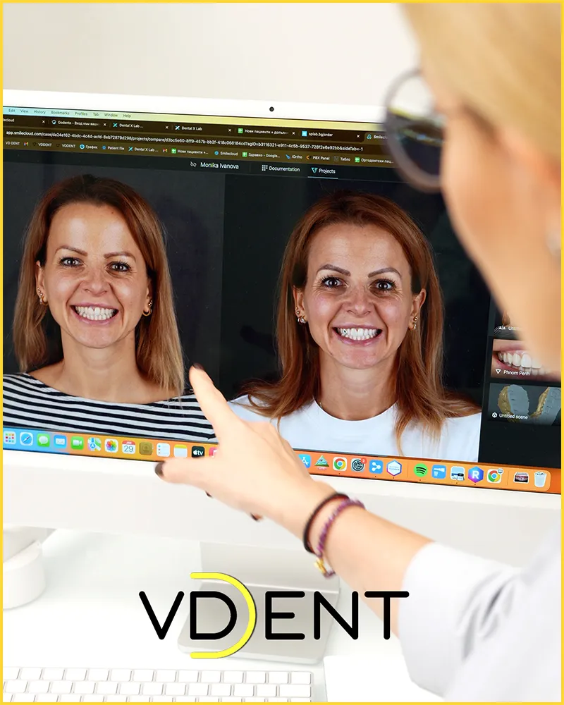 Дигитално планиране за алайнери за зъби invisalign - за възрастни и деца