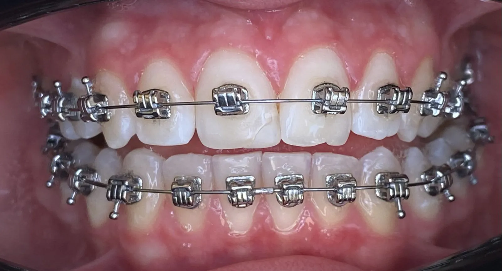 Поставяне на брекети за изправяне на зъби в София